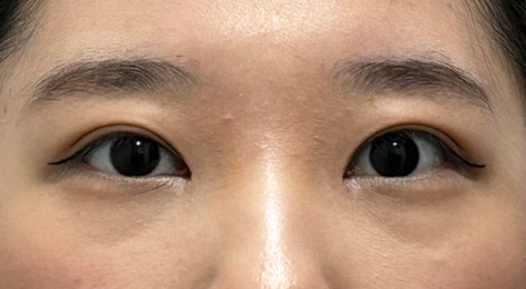 시술전사진