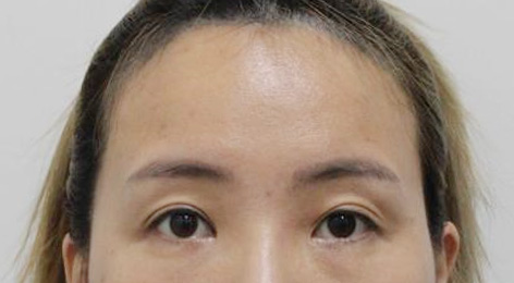 시술전사진