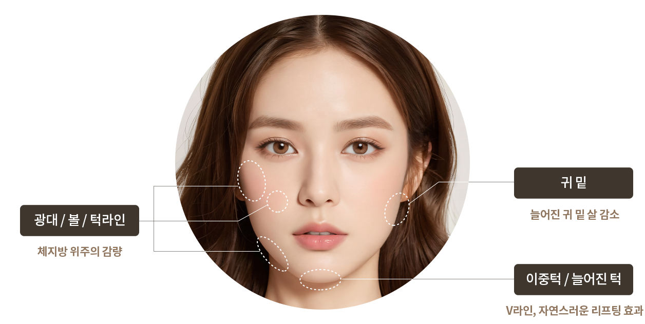 윤곽주사